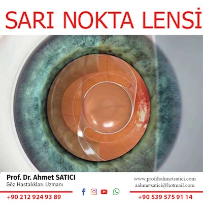 Sarı Nokta Lensi (Scharioth Macula Lens)