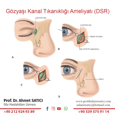 Gözyaşı Kanal Tıkanıklığı Ameliyatı (DSR)