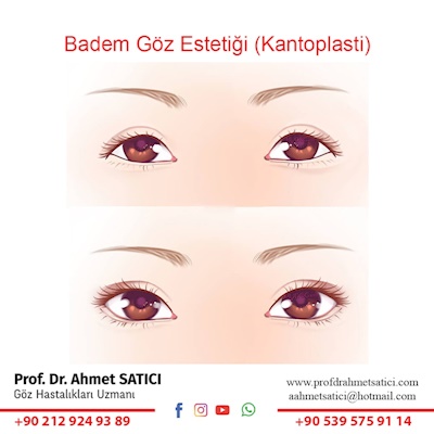 Badem Göz Estetiği  (Kantoplasti)